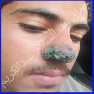 قبل العلاج