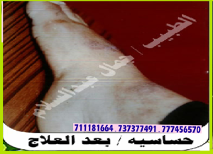 الحساسية بعد العلاج