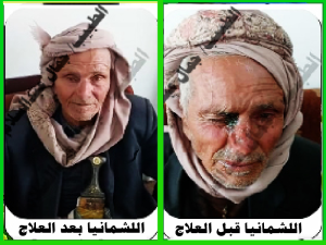 اللشماتيا قبل وبعد العلاج