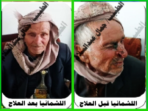 اللشماتيا قبل وبعد العلاج