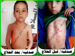 الصدفية قبل بعد العلاج