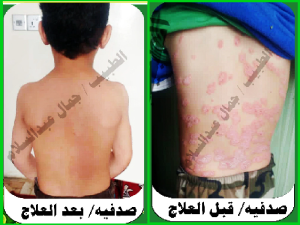 الصدفية قبل بعد العلاج
