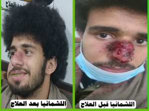 اللشمانيا قبل وبعد العلاج