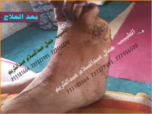 بعد العلاج-01